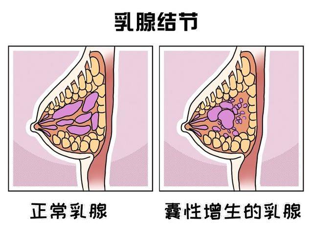 乳腺结节的形成可能是乳房发生感染或损伤,或是内分泌紊乱,基因突变等