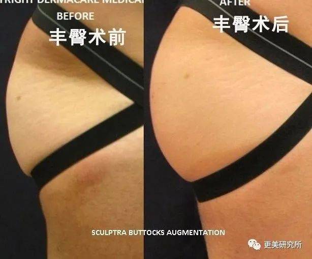 脂肪|鞠婧祎再花70w能do成迪丽热巴的前凸后翘？！