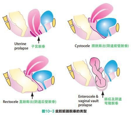 盆腔器官脱垂 盆腔器官脱垂是指盆腔器官和与其相邻的阴道壁突入阴道