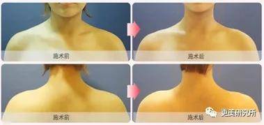 张子枫|曾被关晓彤秒成渣，如今“整容式”长大，削掉斜方肌后美翻