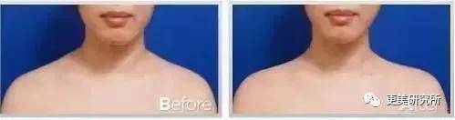 张子枫|曾被关晓彤秒成渣，如今“整容式”长大，削掉斜方肌后美翻