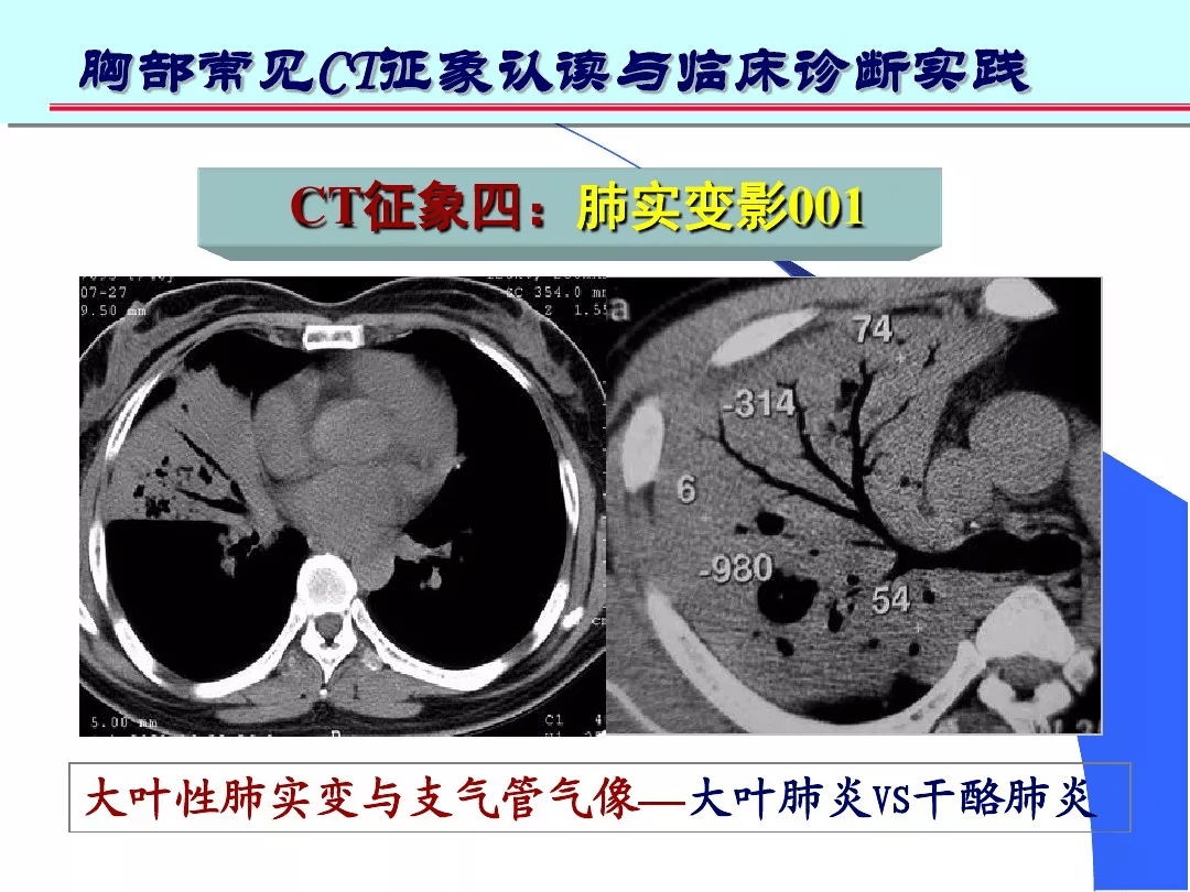 大叶性肺实变:肺结核   大叶干酪肺炎-虫蚀空洞