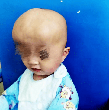 头型|医生一句话惊醒家长湖南发现多例！七个月大宝宝头型酷似外星人