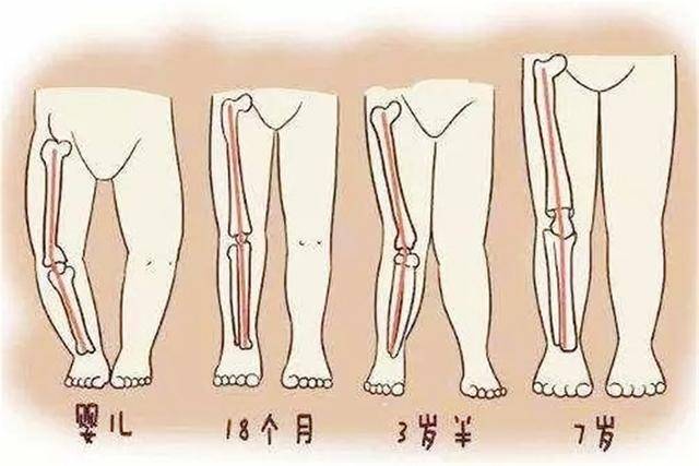 宝宝|娃的腿部发育规律，很多家长不清楚O型腿、X型腿、腿纹不对称