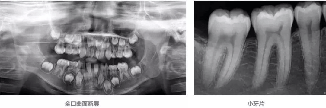 大连齿医生口腔科普 为啥看牙一定要拍x光片?辐射不可怕吗?_牙齿