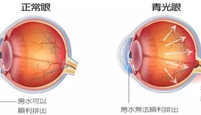 眼压检查能看出青光眼吗 c5213466417e49e2ae3570af1780d397.jpeg