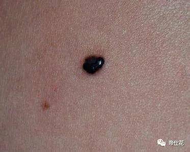 什么是黑色素瘤是怎么引起的 20b24e3724234d44a41639c5d5712821.jpeg