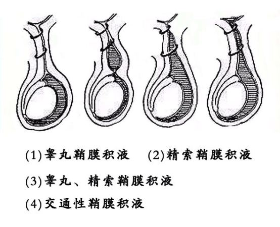 鞘膜积液会导致不育?鞘膜积液的注意事项