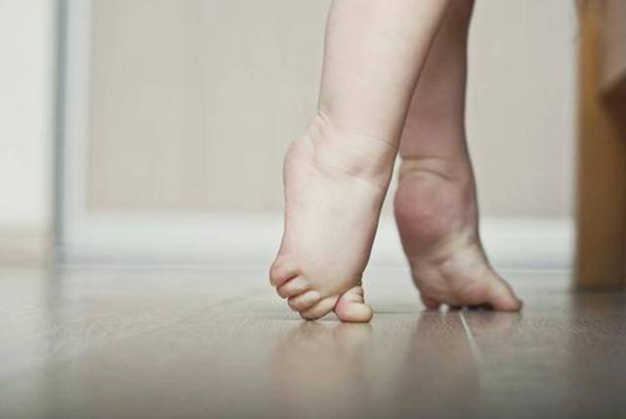 宝宝总爱"踮脚尖"走路是发育异常吗?超过这个年龄,就要警惕了