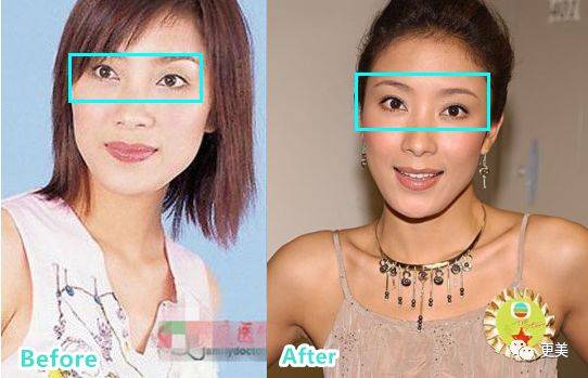 杨怡|曾经tvb一姐，演技一流，也把自己整僵了，假体太明显了...