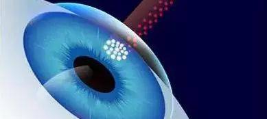 激光近视手术和晶体植入哪个贵 d91278acfb184fe0bc756458999cdea6.jpeg