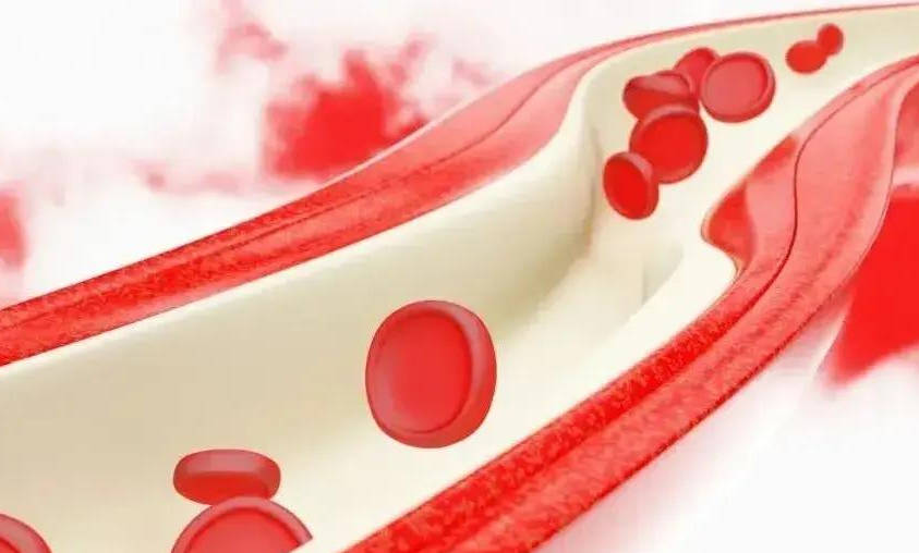 下肢|糖尿病人有水肿，是肾病发生了吗？