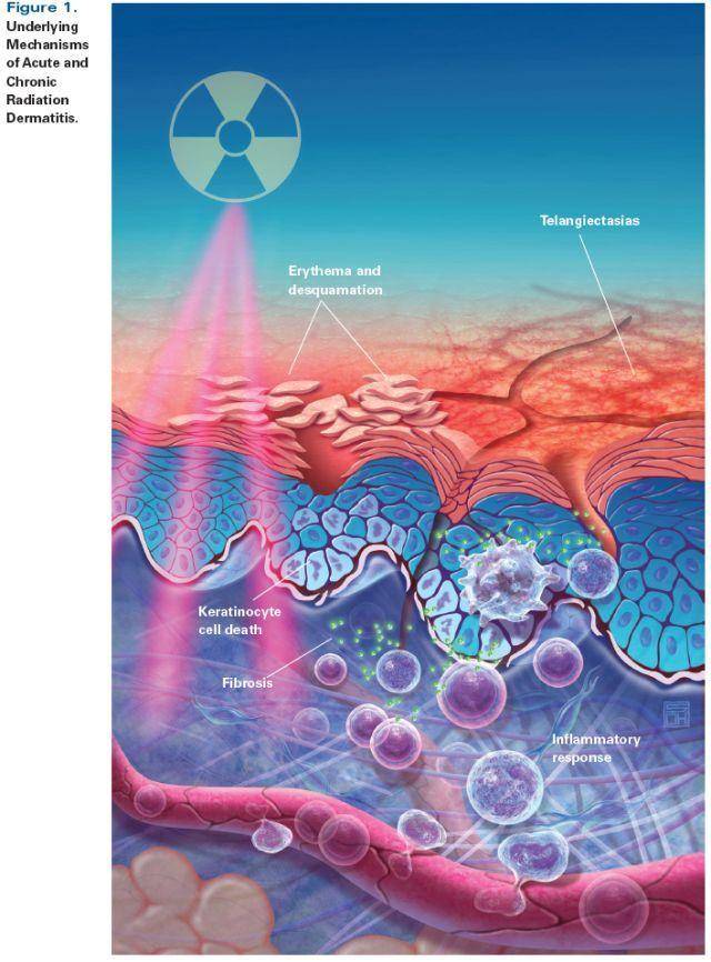 放射性皮炎的预防和处理,葆湿洁带您了解
