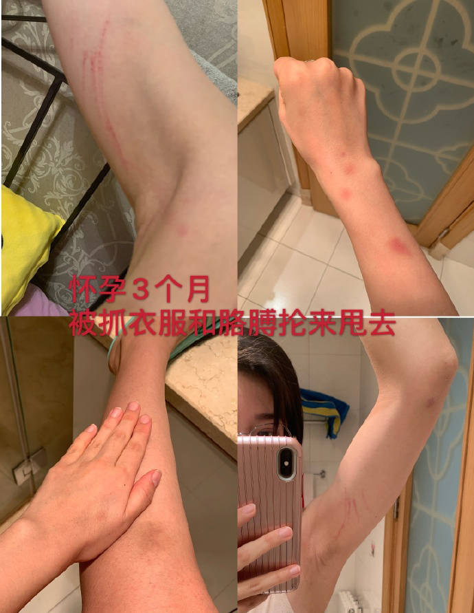 怀孕3个月就被拽着胳膊来回甩,导致胳膊和大腿多出於伤和抓痕.
