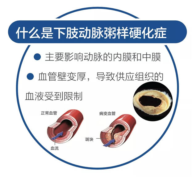 疾病|广安门医院举办“周围血管疾病义诊宣传日”系列活动