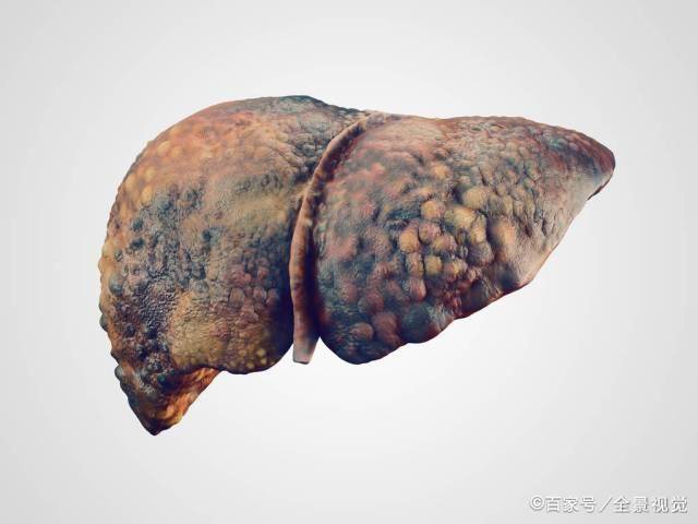 肝硬化产生后还能活多久做好3件事可减缓肝硬化进度