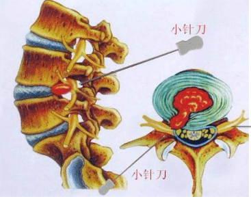 小针刀疗法的优缺点