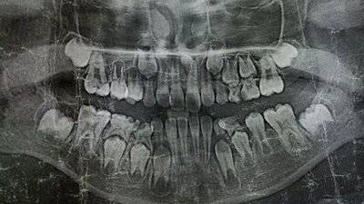 牙的硬度比骨骼还高,仅靠肉眼检查是无法得知牙齿内部情鲻的.