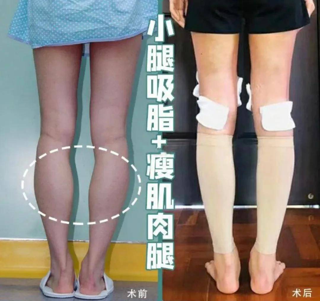 手术|杨幂关晓彤杠上了？撞衫尴尬就算了，还被网友喷做了直腿手术…