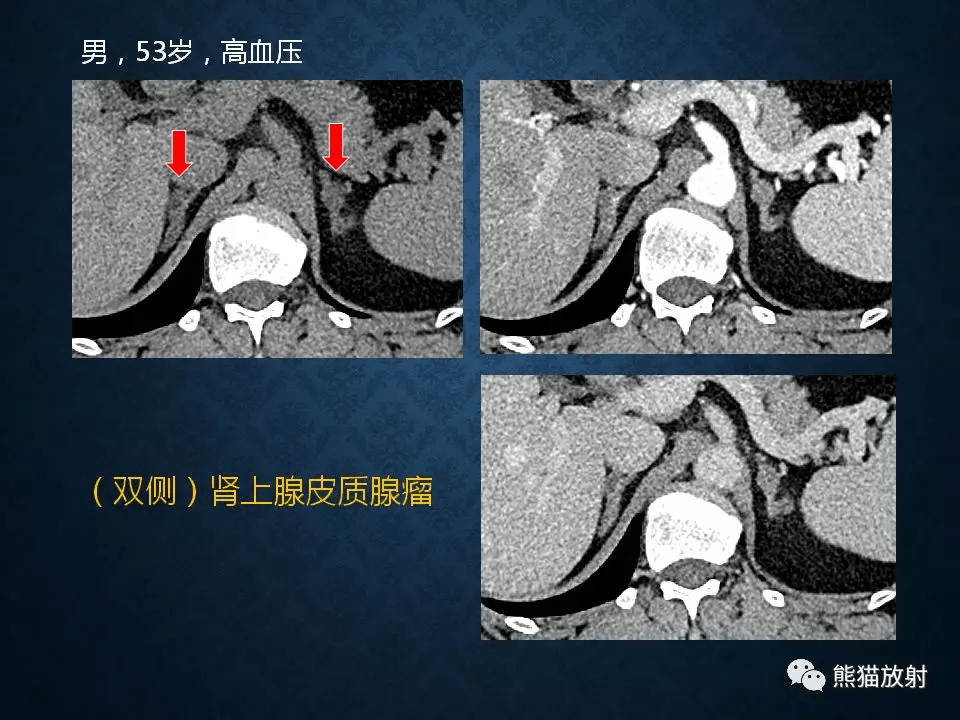 肾上腺扫描方案解剖皮质增生及小腺瘤的诊断