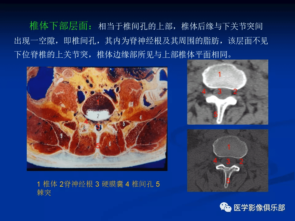 腰椎结核的ct诊断与鉴别