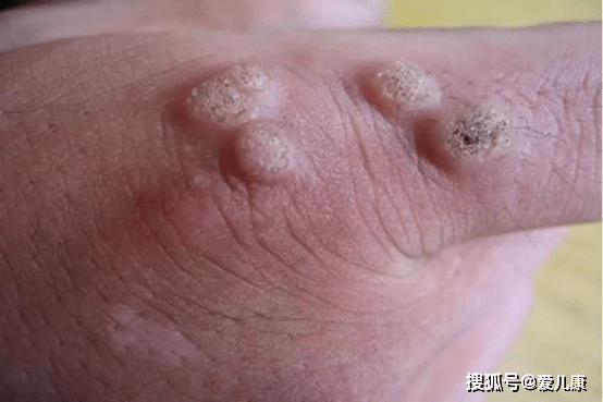 儿童常见的病毒疣,主要是下面的这三类: 1,寻常疣(瘊子,千日疮) 寻常