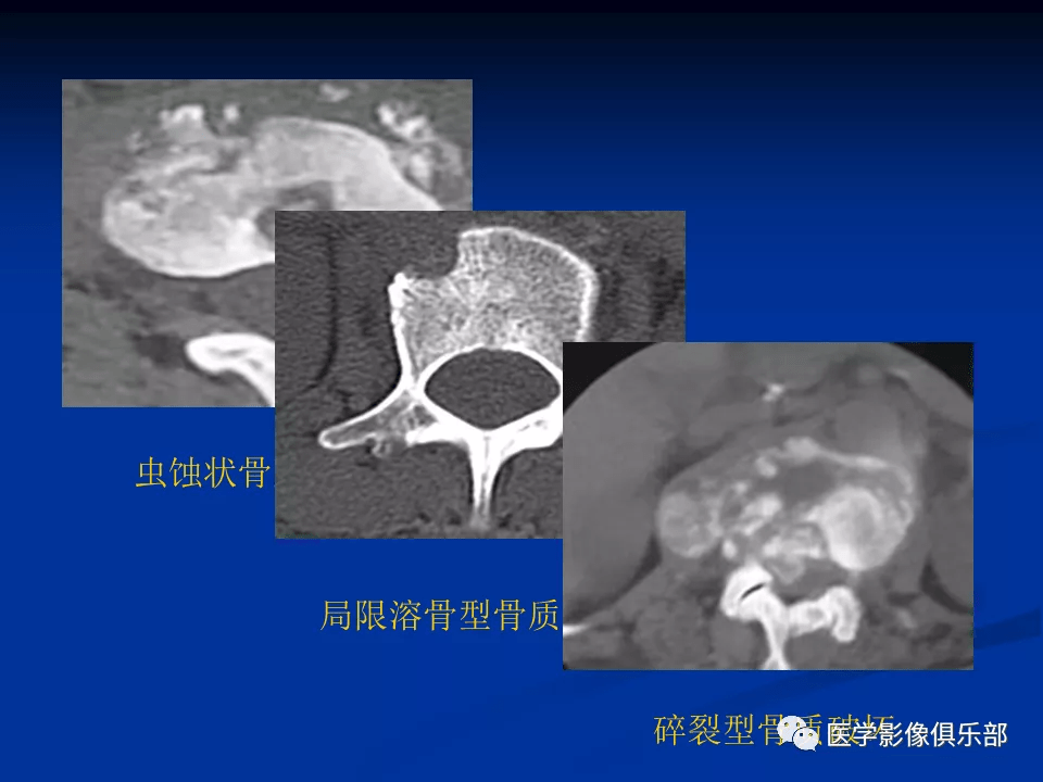 腰椎结核的ct诊断与鉴别