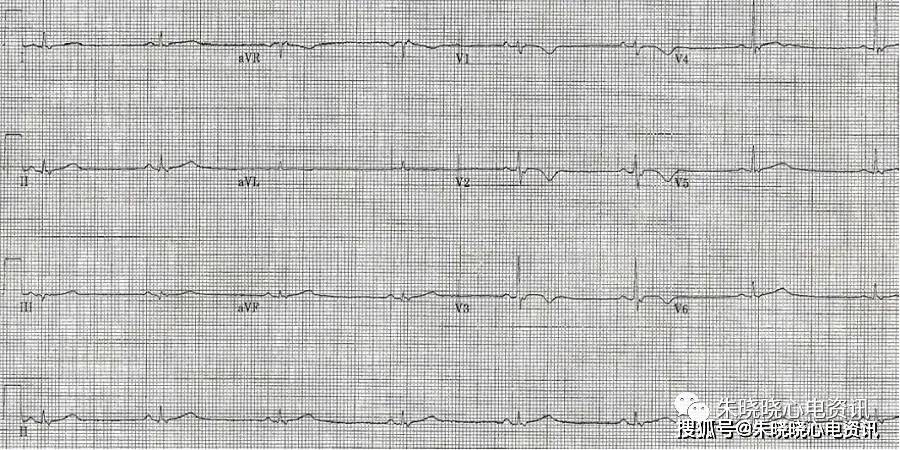带你了解常见心肌病的心电图表现