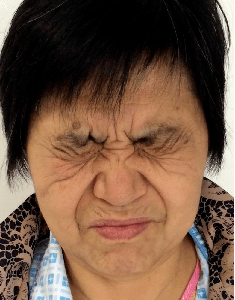 meige综合征常在中年后期或老年期起病，临床以双眼睑痉挛为最常见的首发症状(占76%～77%)