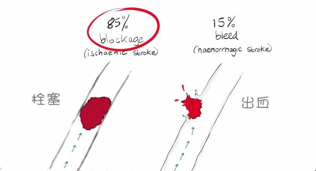 治疗|关于中风，这篇我看懂了！