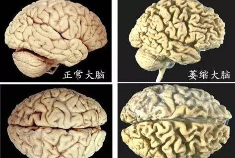 脑萎缩不是一种病,而是指在ct或mri检查时,发现脑组织体积减小和脑室