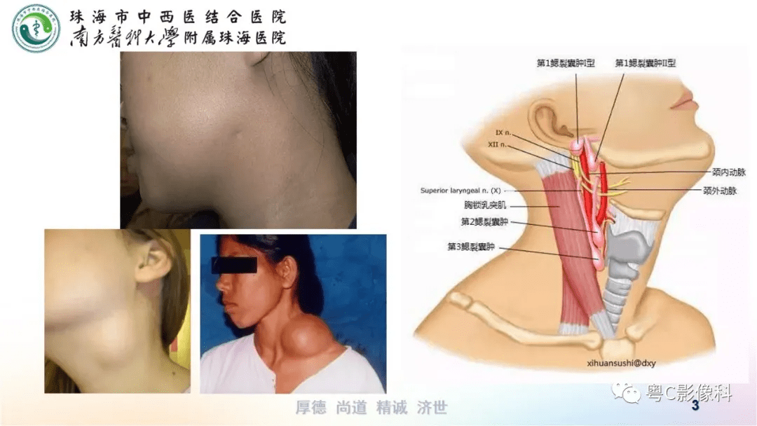 在ct上与囊性淋巴管瘤/甲状舌骨囊肿/神经鞘瘤/皮样囊肿/表皮样囊肿等