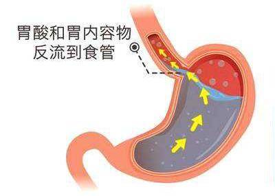 反流性食管炎对身体有哪些危害?