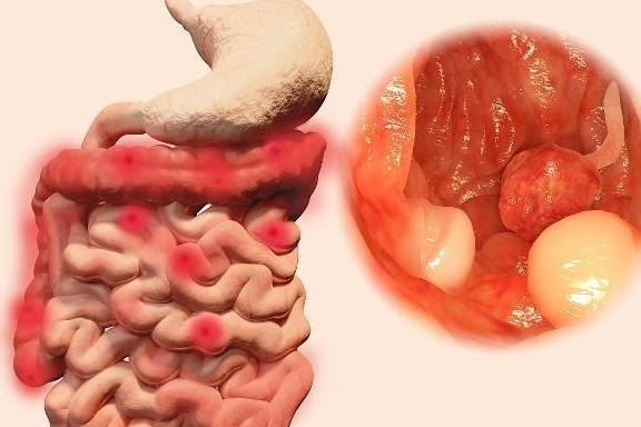 肠道息肉严重吗?别自己吓自己,多注意这些细节就好了