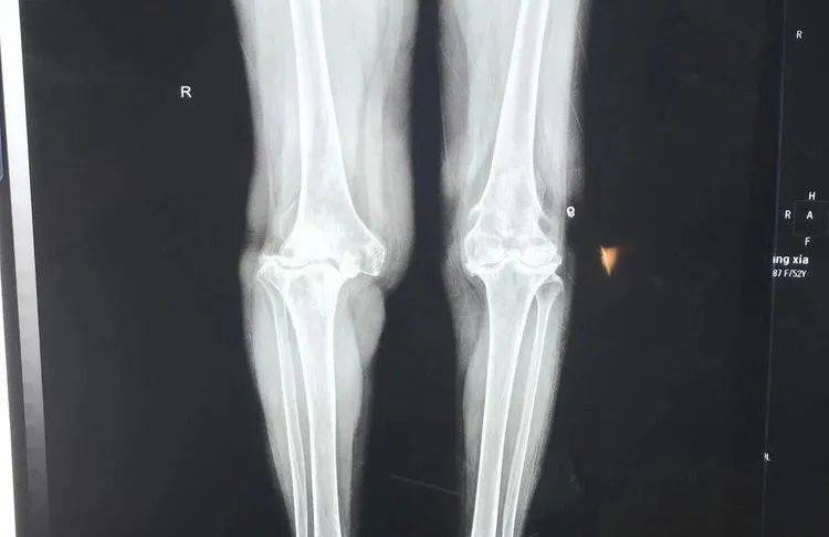 膝关节置换医院排名_膝关节置换图片