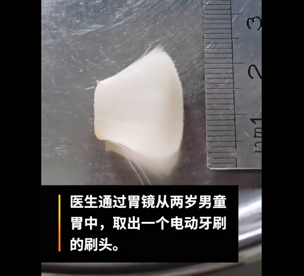 宝宝|医生：孩子这样刷牙才正确2岁男孩误吞电动牙刷头致胃窦出血