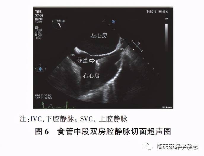 经食管超声心动图在非心脏手术中应用专家共识 (2020版)