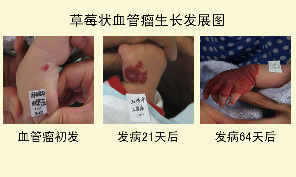 1,血管瘤是一种血管畸形,它有多类划分,如草莓状血管瘤,混合型血管瘤