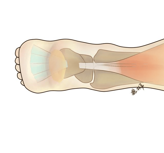 垫脚|足跟酸痛、僵硬？垫脚尖困难？医生教你在家自查跟腱健康状况