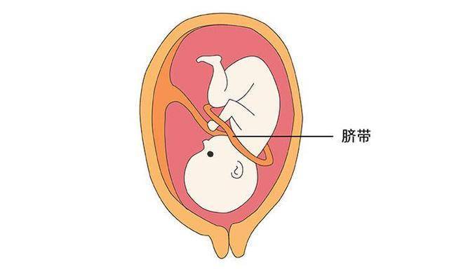 单脐动脉怎么办