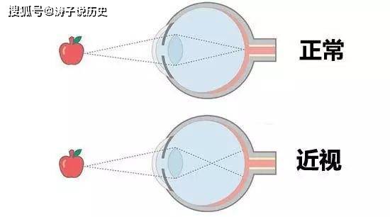 手术治疗近视是什么原理_近视激光手术原理图解(2)