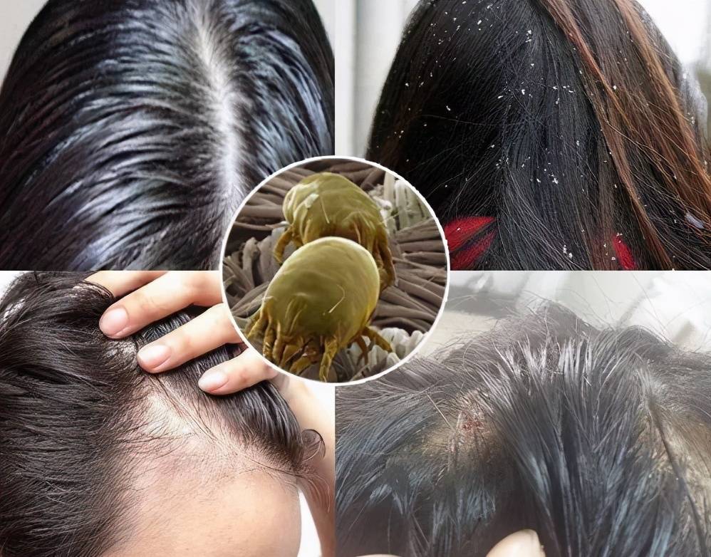 马拉色菌在头皮上的大量繁殖引起头皮角质层的过度增生,致使角质层