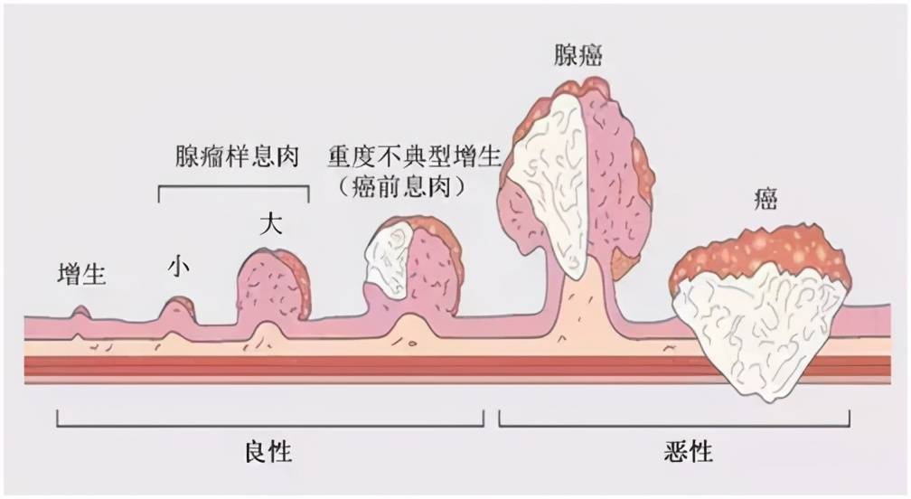 原创肛门长个小肉球,难道是肠癌前兆?杨大夫告诉你怎么处理