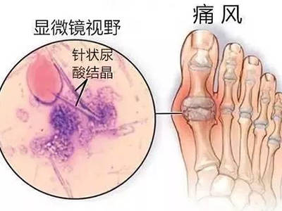 怎么自己测试尿酸 24d00e7557b740aab3aa2a09c453922b.jpeg