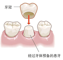 单纯用材料已经没法恢复功能根管治疗后需要做牙冠,原因有三
