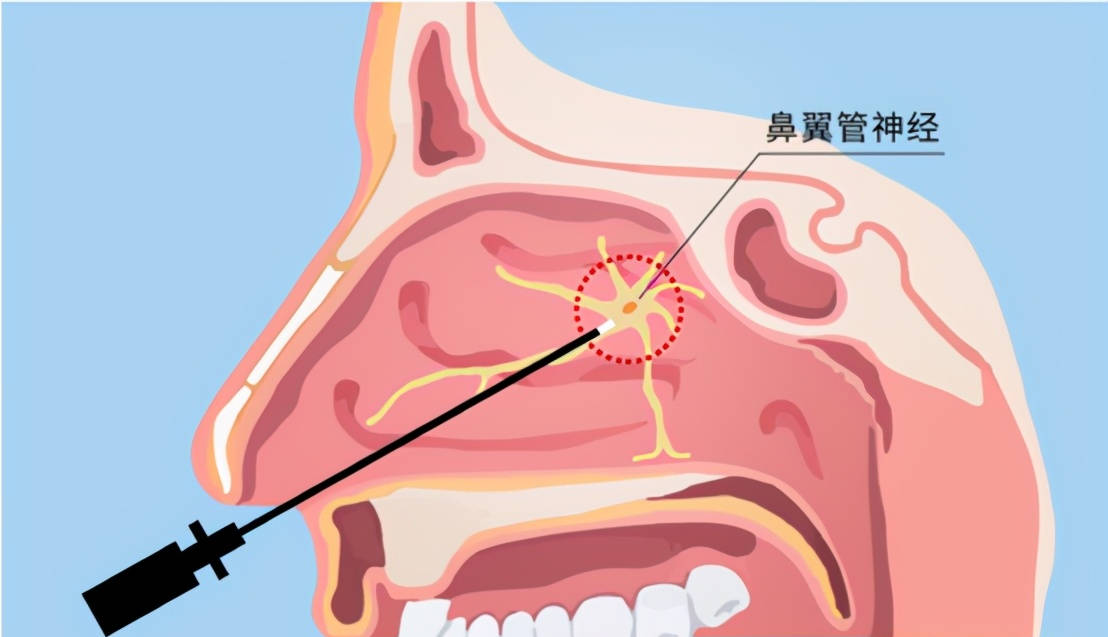 治来治去老是复发,过敏性鼻炎,真的治不好吗?