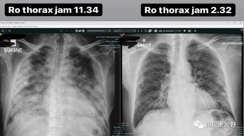医生拍下x光片,印尼新冠患者9小时肺部变化令人震惊.