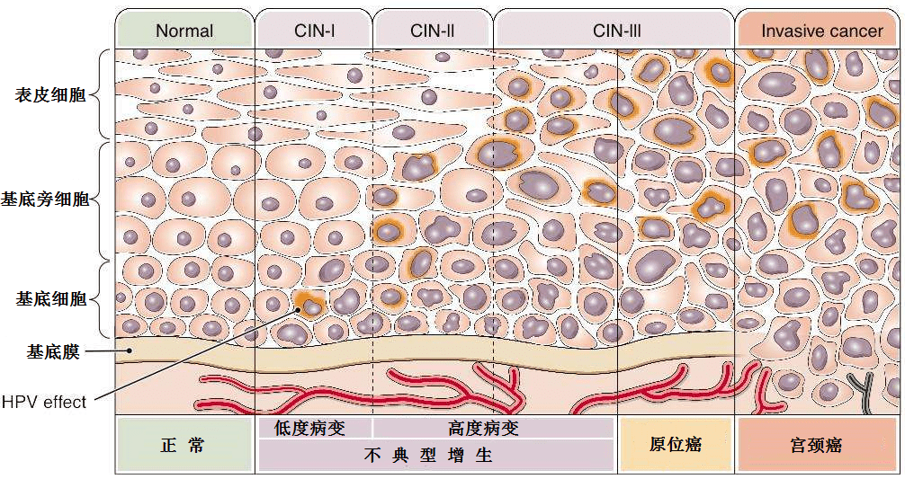 从hpv感染到宫颈癌到底有多远