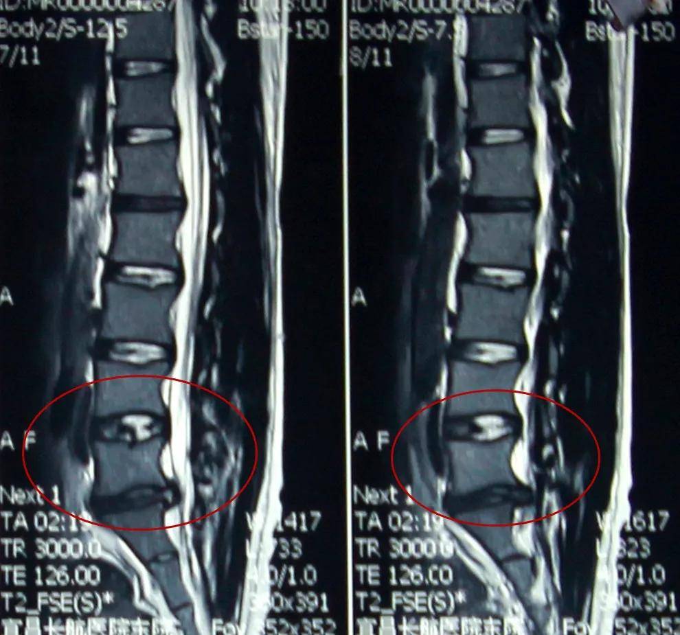 周老师术前片子显示l5/s1椎间盘突出最严重
