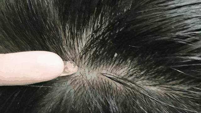 原创从头皮上抠出的白色小颗粒是粉刺还是污垢这4种原因要重视